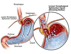 Рефлюкс-эзофагит заброс желудочного содержимого в пищевод